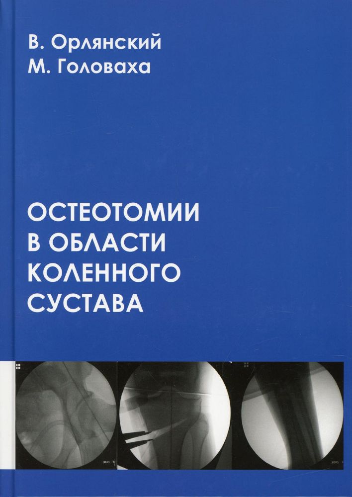 Остеотомии в области коленного сустава: монография