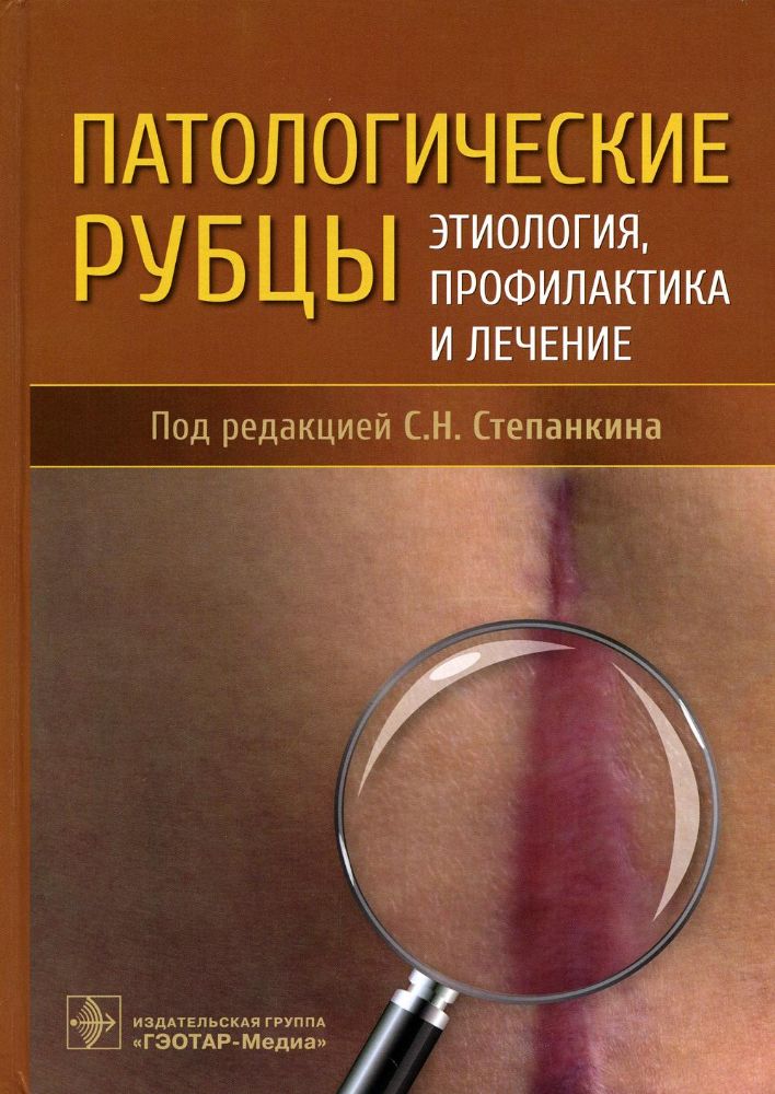 Патологические рубцы. Этиология, профилактика и лечение