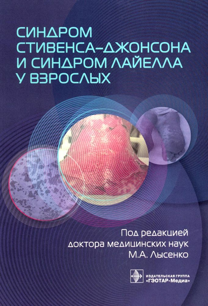 Синдром Стивенса–Джонсона и синдром Лайелла у взрослых