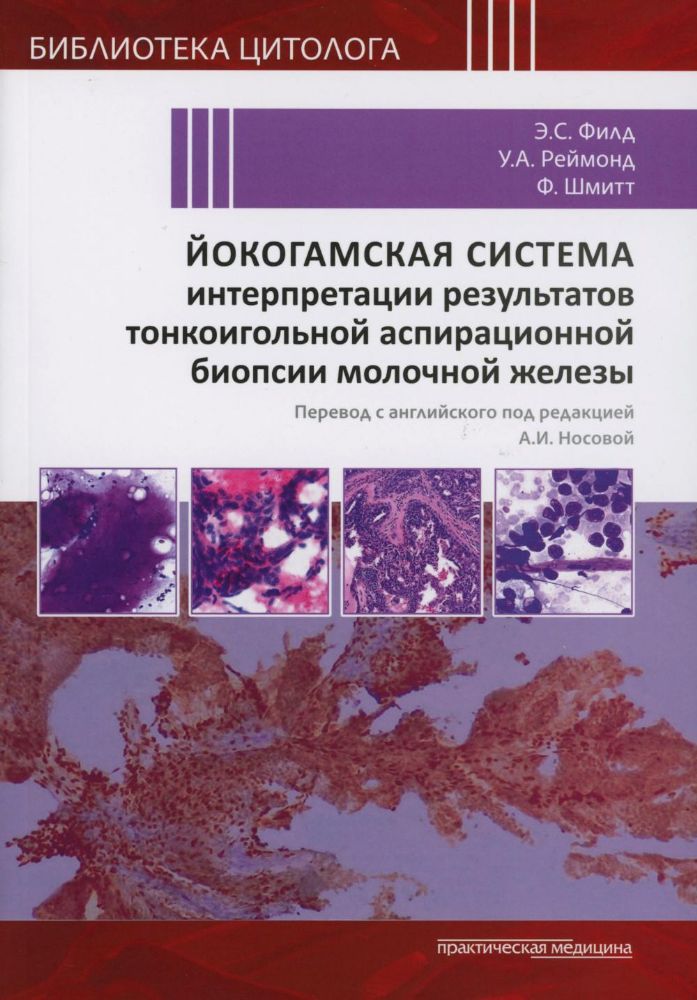 Йокогамская система интерпретации результатов тонкоигольной аспирационной биопсии молочной железы