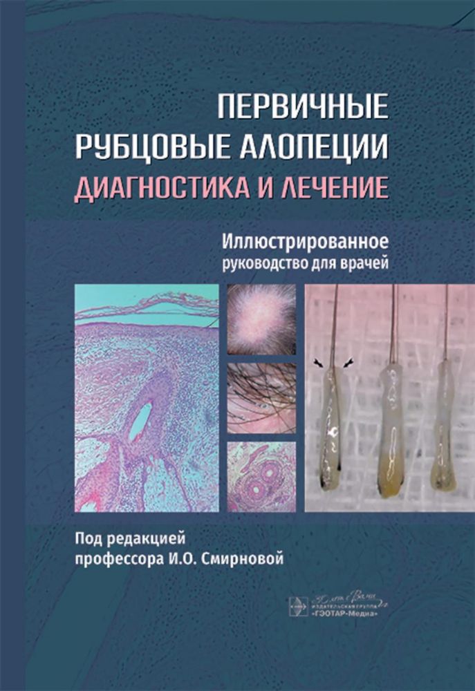 Первичные рубцовые алопеции.Диагностика и лечение.Илл.руковод.для врачей