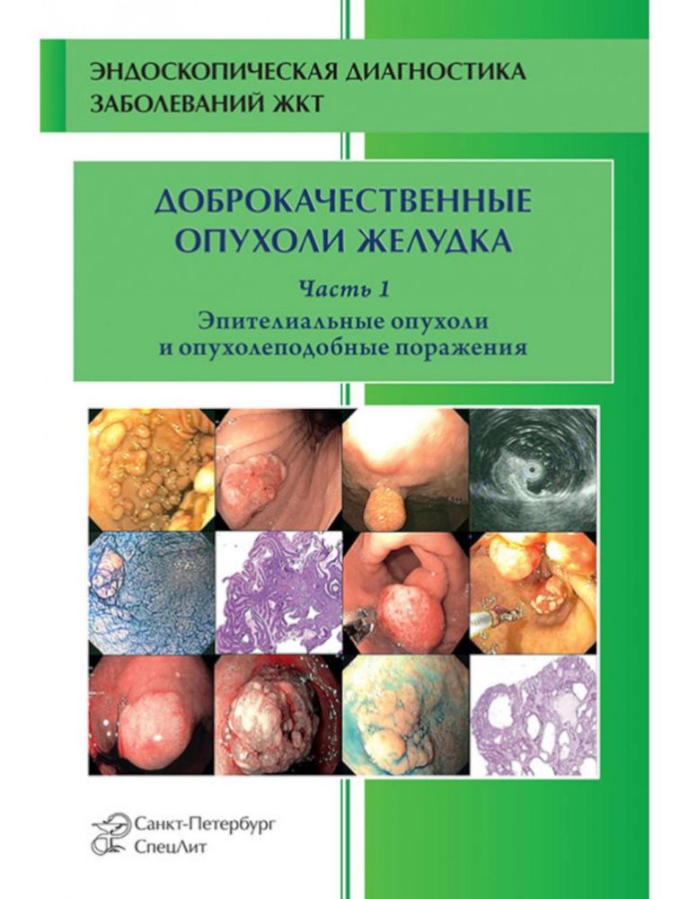 Доброкачественные опухоли желудка. Ч. 1: Эпителиальные опухоли и опухолеподобные поражения: Учебно-методическое пособие. 2-е изд., испр. и доп